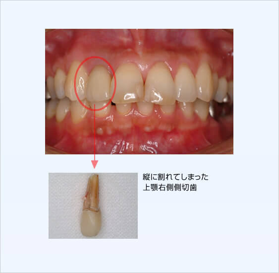インプラント治療のご相談は沼津市の歯医者「中島歯科医院」へ。